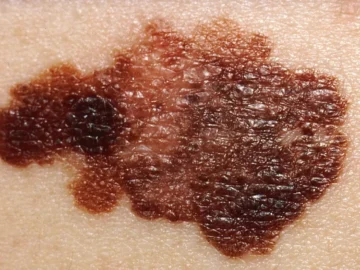 A simple test that diagnoses skin cancer at home
 arabausa