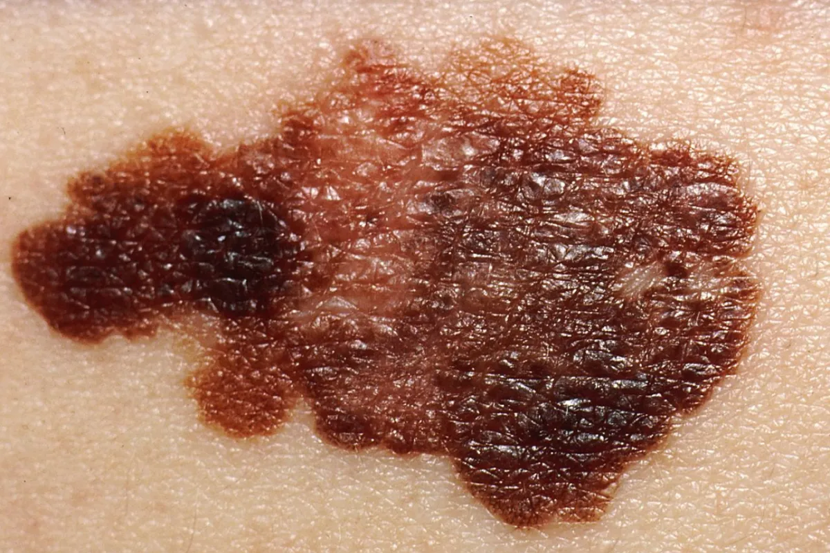 A simple test that diagnoses skin cancer at home
 Arabausa