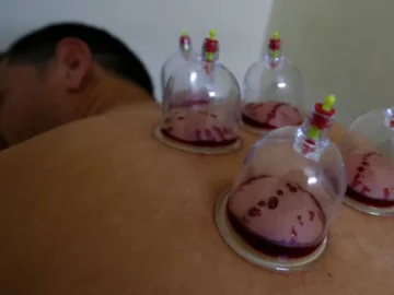 What are the most prominent benefits of cupping therapy? Arabausa