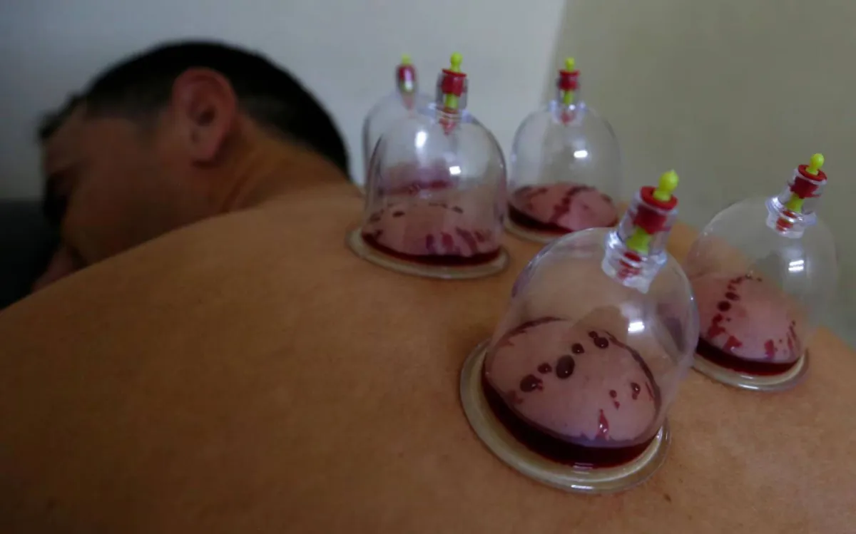 What are the most prominent benefits of cupping therapy?
Arabausa