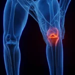 Treatment for the fragility of the items without surgery

 Arabausa