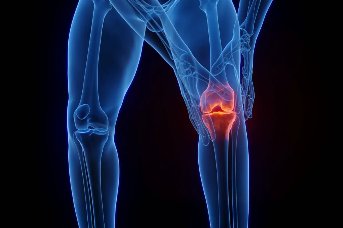 Treatment for the fragility of the items without surgery
Arabausa