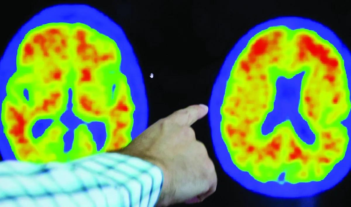 A study reveals major difference between men and women in alzheimer
Arabausa